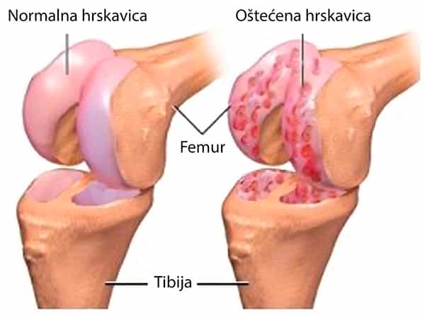 Tratamiento artrosis articular - blog farmacia 24h - Farmacia 24 horas Palma | Farmacia Balanguera